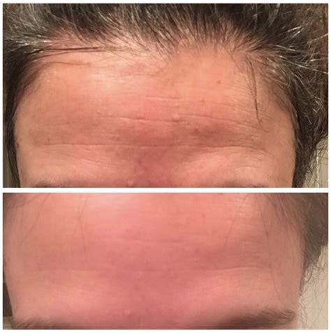 face rolling before and after|dermaroller before and after wrinkles.